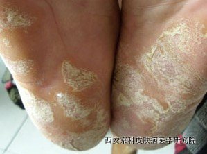 寻常型牛皮癣如何识别
