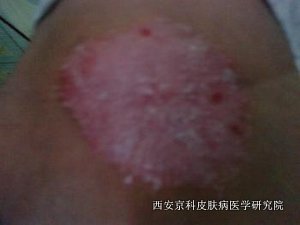 牛皮癣的初期症状