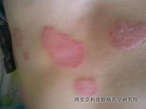 哪些会诱发牛皮癣