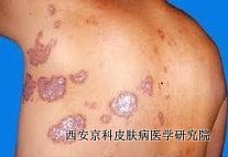 牛皮癣该怎么护理才好