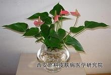 怎么注意牛皮癣治疗事项