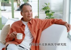 怎么治疗老年牛皮癣