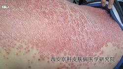 寻常型牛皮癣分为哪几个时期