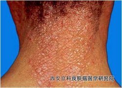 怎么预防颈部牛皮癣