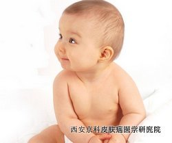 怎样治疗小儿关节型牛皮癣最好