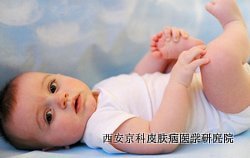 怎样诊断尿布牛皮癣