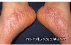 双脚牛皮癣诊断方法