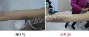 银屑病常见的护理方法