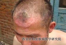 头部牛皮癣怎么诊断