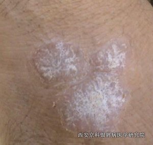 怎么预防牛皮癣病