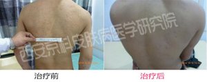 日常生活中如何护理牛皮癣