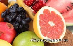 牛皮癣饮食上应注意些什么