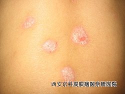 牛皮癣的护理要注意哪些