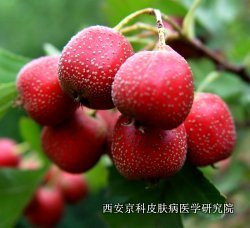 牛皮癣在食物上有什么注意的
