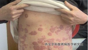 黏膜牛皮癣临床表现