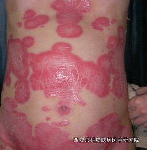 牛皮癣有遗传性吗