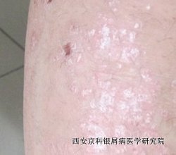 怎样辨别是否患牛皮癣