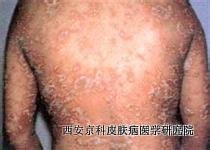 老年牛皮癣护理
