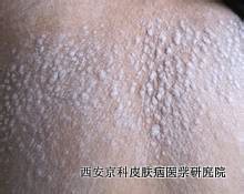 治疗早期中老年牛皮癣的要素