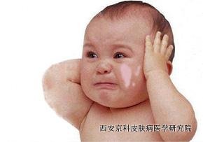 怎么疏导儿童牛皮癣心理
