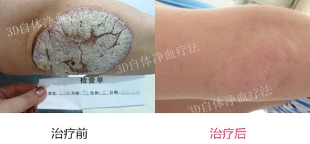 牛皮癣的治疗方法是什么