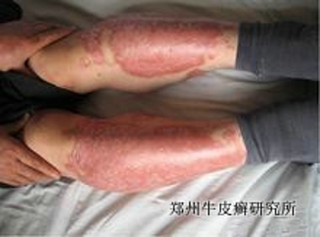 小儿牛皮癣早期有哪些症状