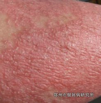 牛皮癣是否传染