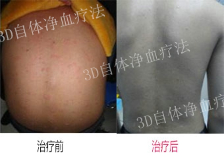 寻常型牛皮癣怎么治疗效果最好