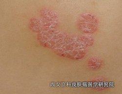 牛皮癣早期什么表现 牛皮癣早期什么表现