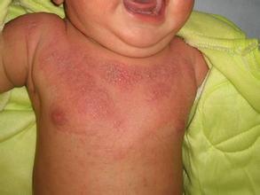 婴儿银屑病不同类型症状表现